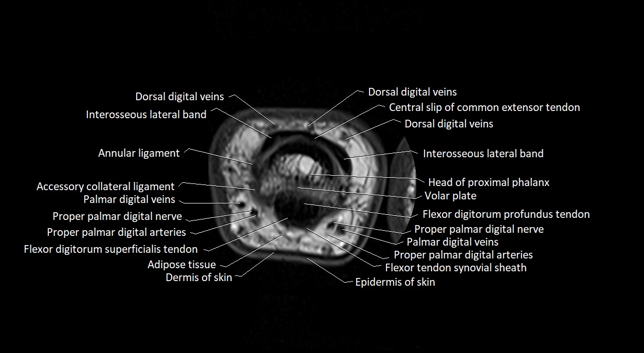 Finger anatomy axial cross sectional 3T image image 14.webp